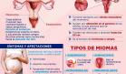 Miomas uterinos | Infografía