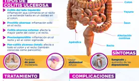 Colitis ulcerosa | Infografía