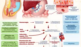 Fisiopatología del síndrome hepatorrenal | y lesión renal aguda en pacientes con cirrosis | Infografía