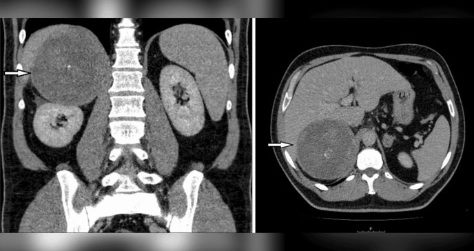 Fiebre recurrente conlleva a diagnóstico de angiosarcoma de glándula suprarrenal derecha