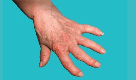 EULAR 2024: Establecen vínculo entre la menopausia y la exacerbación sintomática de artritis reumatoide