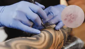 ¿Por qué los tatuajes pueden ser un factor de riesgo para el desarrollo de un linfoma?