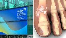 EULAR 2024: ¿Influye el uso de metformina para el riesgo de gota en pacientes prediabéticos?