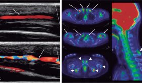 Pacientes de arteritis de células gigantes y polimialgia reumática buscan más sobre tratamientos en redes