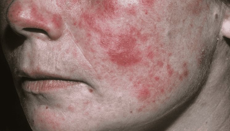 Nuevo fármaco TYK2 logra respuesta en lupus eritematoso sistémico con baja actividad en menor tiempo Nuevo fármaco TYK2 logra respuesta en lupus eritematoso sistémico con baja actividad en menor tiempo