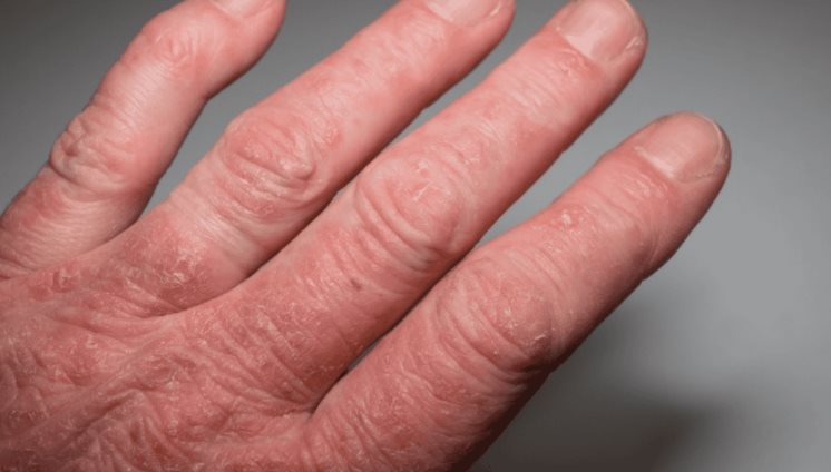 Bloqueadores de IL-12/23 para psoriasis podrían reducir riesgo de desarrollar artritis psoriásica Bloqueadores de IL-12/23 para psoriasis podrían reducir riesgo de desarrollar artritis psoriásica