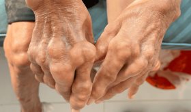 Primera consulta por brote de gota estaría asociada a futuros eventos de riesgo cardiovascular