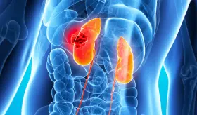 Desarrollan nueva terapia de anticuerpos eficaz para c&aacute;ncer de ri&ntilde;&oacute;n uniendo c&eacute;lulas T con c&eacute;lulas tumorales