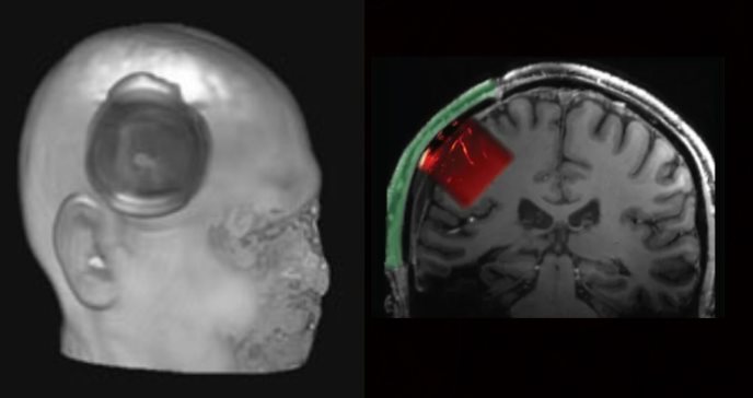 Científicos implantan ventana acústica transparente para monitorear actividad cerebral con ultrasonido