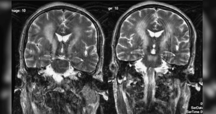 Detectan "signo de copa" en paciente con esclerosis lateral primaria y afectación en vía corticoespinal