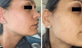 Reportan caso de grave reacción alérgica aguda en paciente por altas dosis de ibuprofeno