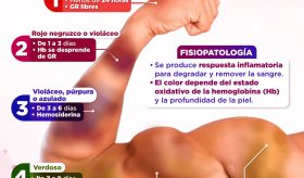 Equimosis: escala cromo-crónica | Infografía