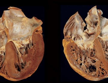 Cor pulmonale: el trastorno cardíaco por engrosamiento relacionado con las enfermedades pulmonares