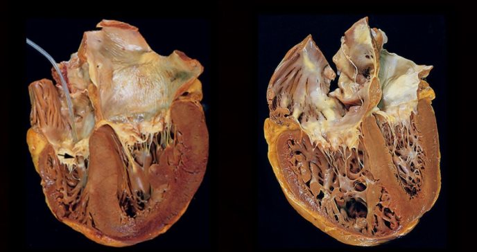 Cor pulmonale: el trastorno cardíaco por engrosamiento relacionado con las enfermedades pulmonares