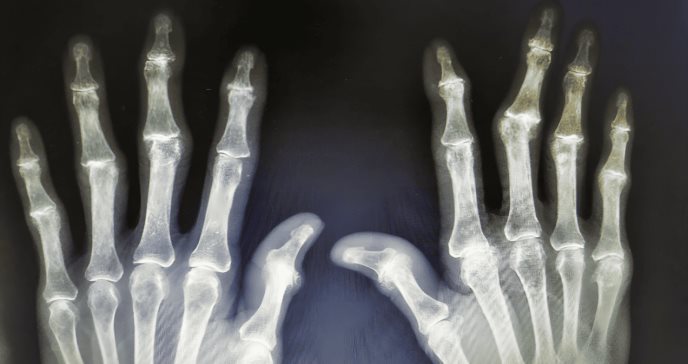 Exposición a dioxinas y policlorobifenilos no aumentan el riesgo de artritis reumatoide en mujeres