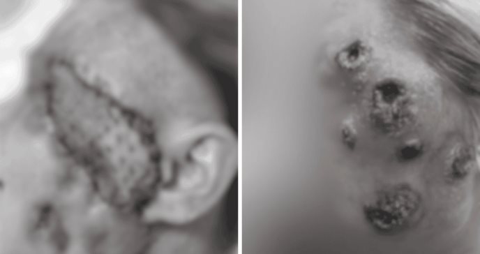 Confunden celulitis facial con viruela bovina en una mujer con dermatitis atópica