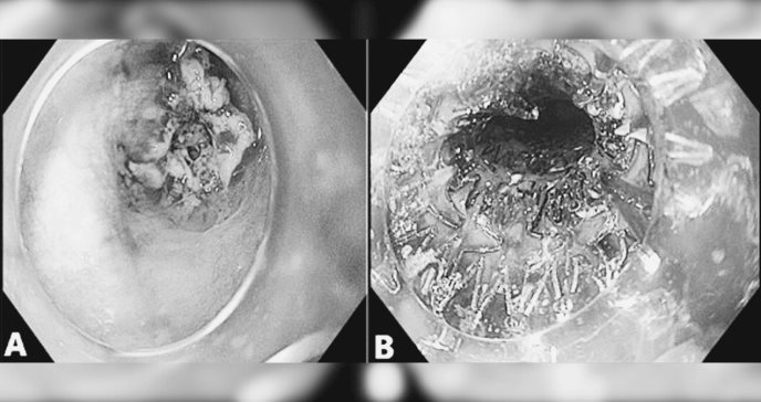 Paciente con cáncer de esófago desarrolla fibrilación auricular tras colocación de un stent esofágico