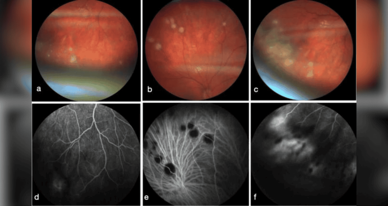 Linfoma de Hodgkin se presenta mediante inusual inflamación y dolor ocular en joven paciente