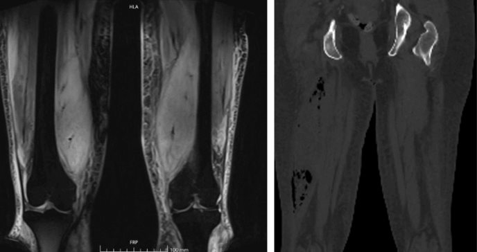 Describen raro caso de mionecrosis diabética complicada con piomiositis y absceso por E. Coli