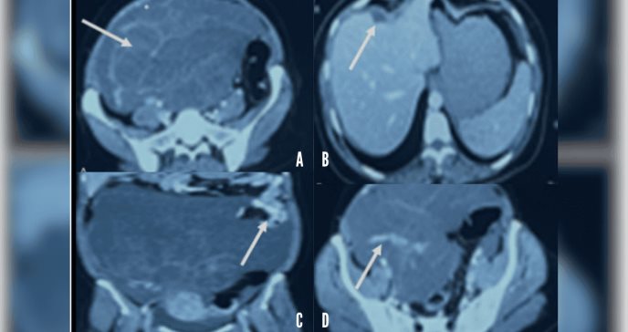 Reportan inusual hallazgo de pseudomixoma peritoneal o "barriga gelatinosa" por tumor ovárico