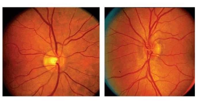 Identifican posible vínculo entre semaglutida y pérdida de visión en pacientes con diabetes y obesidad