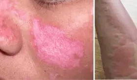 Infecciones intercurrentes estarían vinculadas con el aumento de brotes de lupus eritematoso sistémico