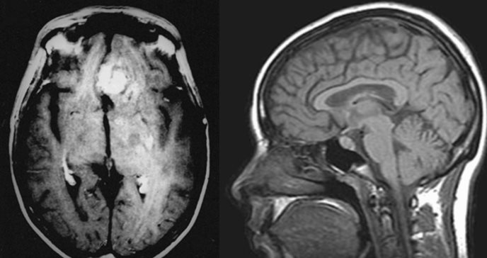 Los tumores cerebrales en niños con neurofibromatosis podrían prevenirse con fármaco para la epilepsia