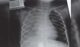 Contusión pulmonar: ¿Cómo diferenciarla de otras lesiones pulmonares?