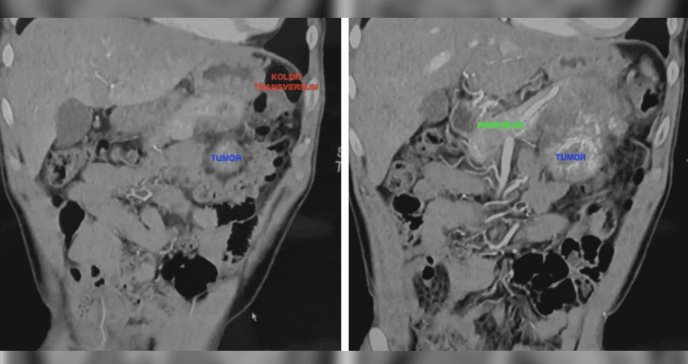 Dolor lumbar persistente deriva en diagnóstico de osteosarcoma extraesquelético en tejidos blandos