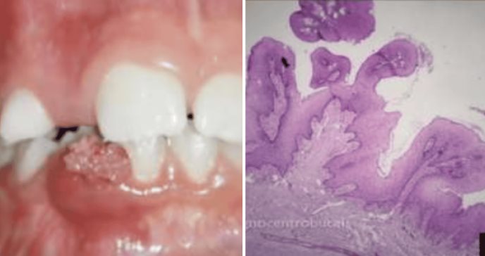 Detectan lesión por papiloma humano en encía de menor sin antecedentes de contagio vertical