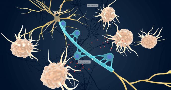 Descubren diferencias moleculares significativas entre 4 subtipos de Esclerosis Lateral Amiotrófica