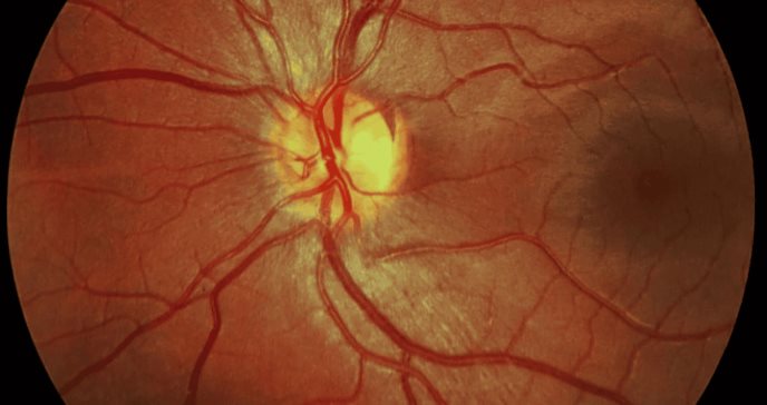 Descubren relación entre los niveles altos de tensión arterial y alteraciones en la retina