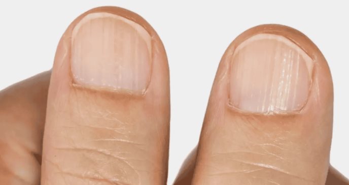 ¿Conoce el significado de las rayas en las uñas? Un posible indicio de problemas de salud, según expertos