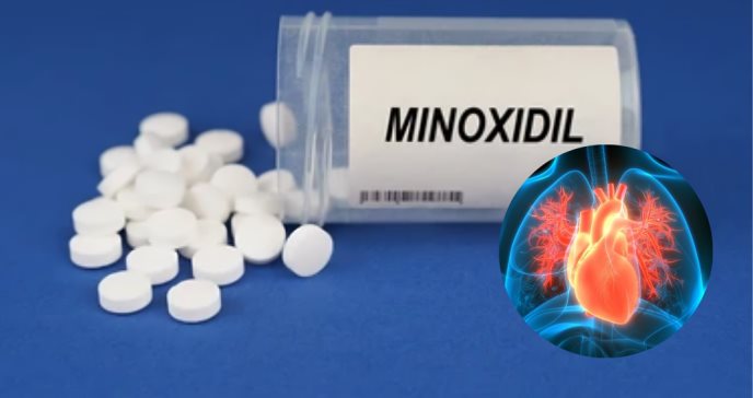 Advierten sobre los posibles efectos adversos del consumo de minoxidil oral por prescripción