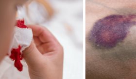 Nuevo tratamiento para la hemofilia ‘A’ es capaz de disminuir los episodios hemorrágicos en niños