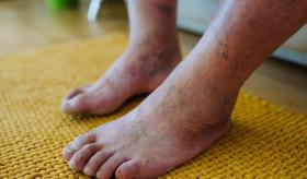 Pie diabético: Lanzan guías para diagnosticarlo y tratarlo mejor
