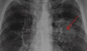Sarcopenia puede predecir complicaciones para pacientes con cáncer de pulmón avanzado