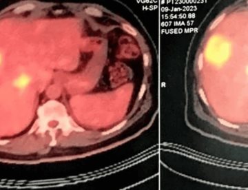 Detectan cáncer esofágico en paciente con debilidad muscular y engrosamiento palmoplantar 