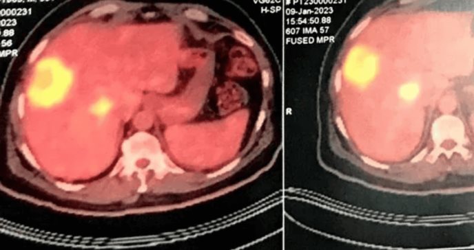 Detectan cáncer esofágico en paciente con debilidad muscular y engrosamiento palmoplantar 