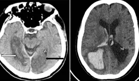Síndrome de Anton-Babinski: La ceguera cortical que engaña al cerebro, haciendo creer que ve
