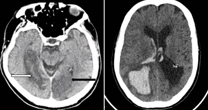 Síndrome de Anton-Babinski: La ceguera cortical que engaña al cerebro, haciendo creer que ve