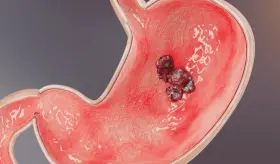 Mini-examen clínico: ¿Puede identificar, diagnosticar y tratar el cáncer gástrico HER2 positivo?