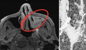 Diagnostican linfoma extraganglionar en puertorriqueño con anorexia y movimientos faciales involuntarios