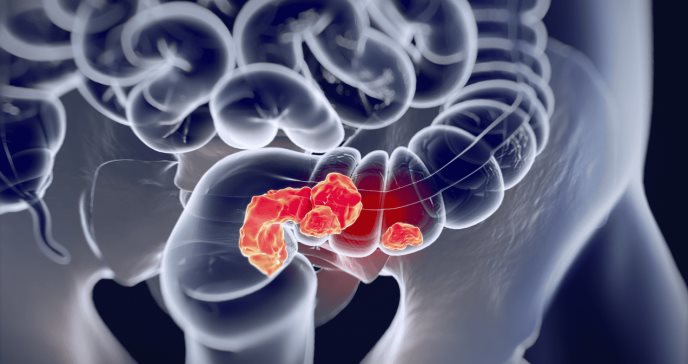 Alteración mecánica en las células del cáncer colorrectal podría evitar el proceso metastásico