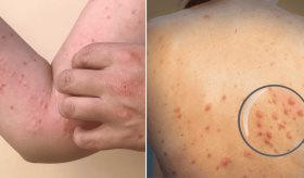 Puerto Rico detecta 48 casos de mpox en 2024 mientras aumenta la preocupación por nueva cepa del virus
