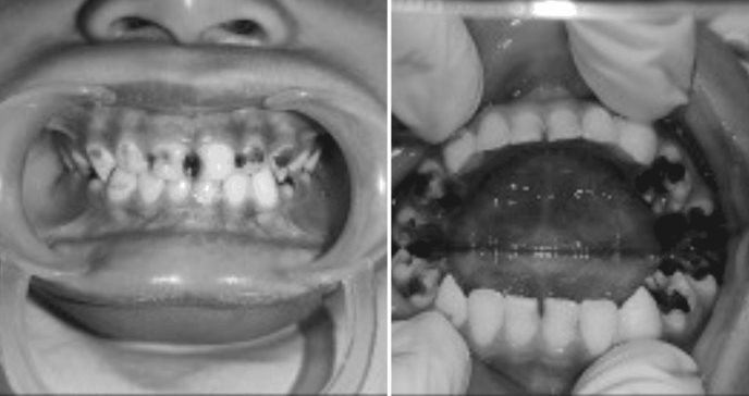 Diagnostican Mucopolisacaridosis Tipo IV en paciente pediátrico con caries moradas y lengua agrandada