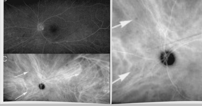 Pérdida gradual de visión y moscas volantes anteceden diagnóstico de edema macular