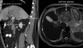 Paciente ingresado por infecci&oacute;n de COVID -19 debut&oacute; con infarto hep&aacute;tico y trombosis de vena porta