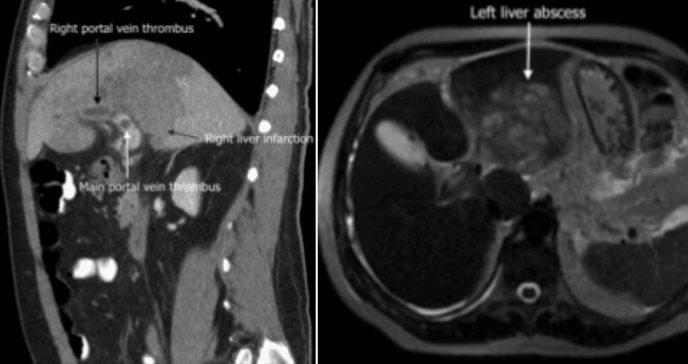 Paciente ingresado por infección de COVID -19 debutó con infarto hepático y trombosis de vena porta