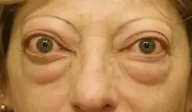 ¿Qué es la oftalmopatía tiroidea y por qué está ligada al hipertiroidismo?